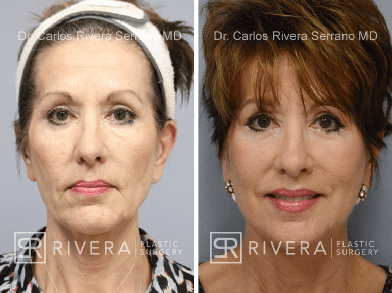 Short scar facelift (mini facelift), fat transfer (grafting) to the face, & TCA peel - Woman - Case 11101 - Before and after – Frontal View