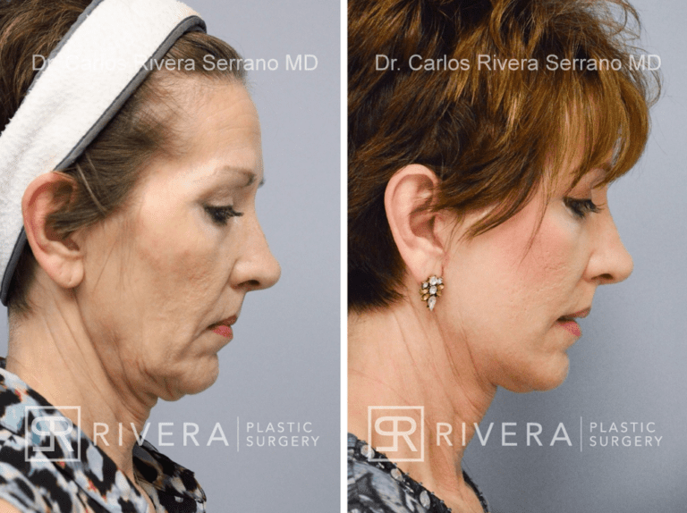 Short scar facelift (mini facelift), fat transfer (grafting) to the face, & TCA peel - Woman - Case 11101 - Before and after – Profile View