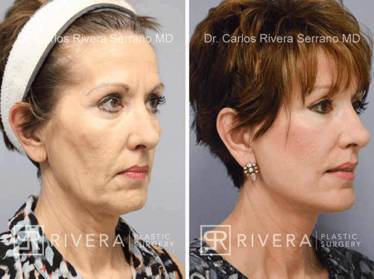 Short scar facelift (mini facelift), fat transfer (grafting) to the face, & TCA peel - Woman - Case 11101 - Before and after – Oblique View