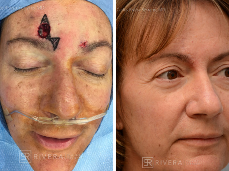 potrait eyelidperiocularreconstruction case9 dr carlos rivera serrano 1