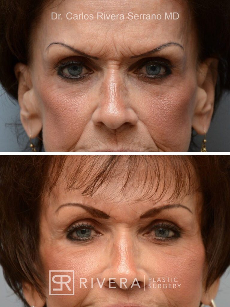 Upper eyelid & brow surgery in female patient - Eyelid & Brow Surgery - Before and after case 9 - Frontal view