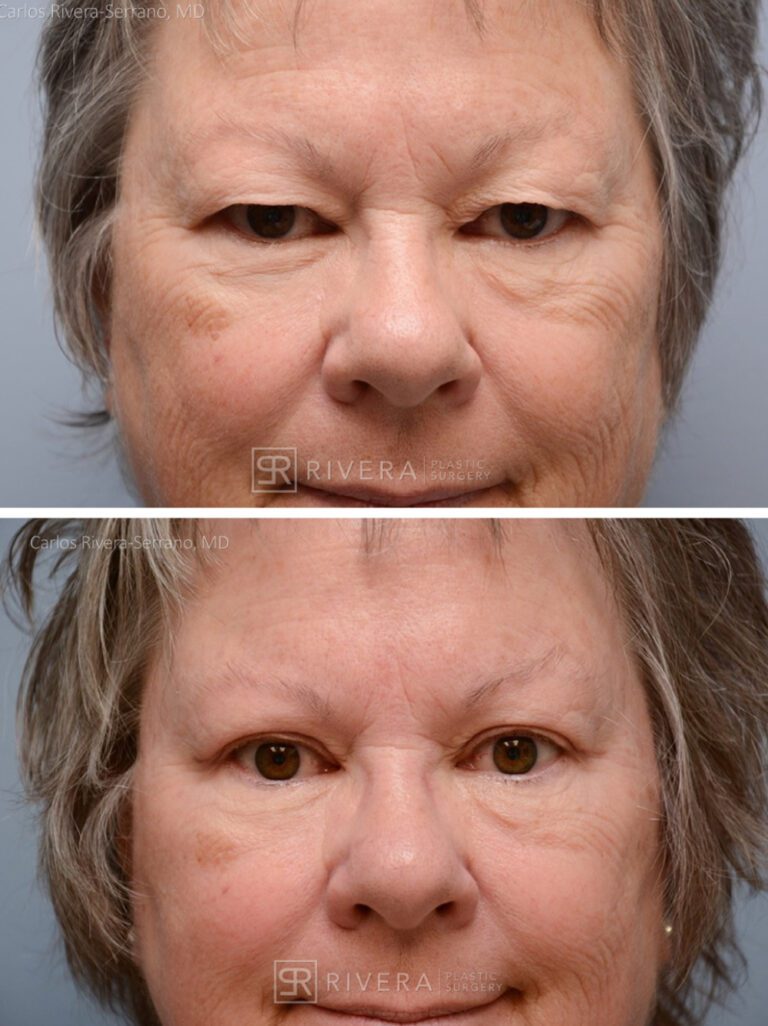 Upper Eyelid Elevation Surgery in female patient - Eyelid & Brow Surgery - Before and after case 2 - Frontal view
