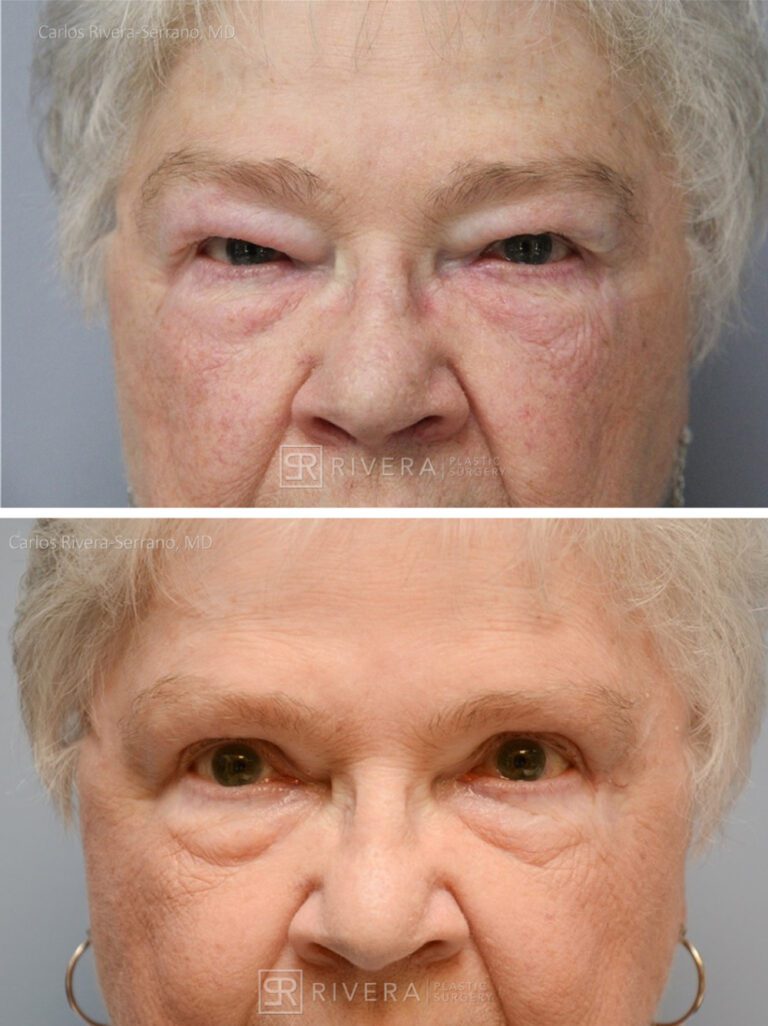 Upper Eyelid Elevation Surgery in female patient - Eyelid & Brow Surgery - Before and after case 3 - Frontal view