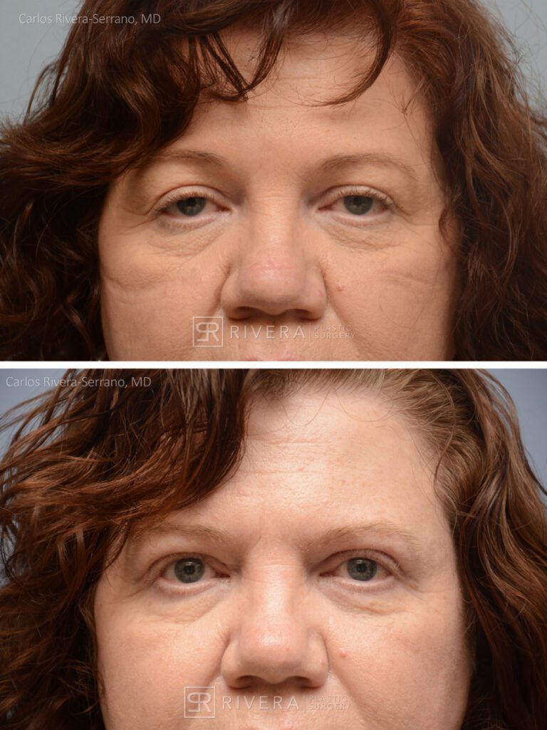 Upper Eyelid Elevation Surgery in female patient - Eyelid & Brow Surgery - Before and after case 4 - Frontal view