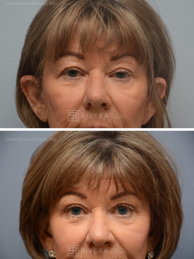 Upper Eyelid Elevation Surgery in female patient - Eyelid & Brow Surgery - Before and after case 5 - Frontal view