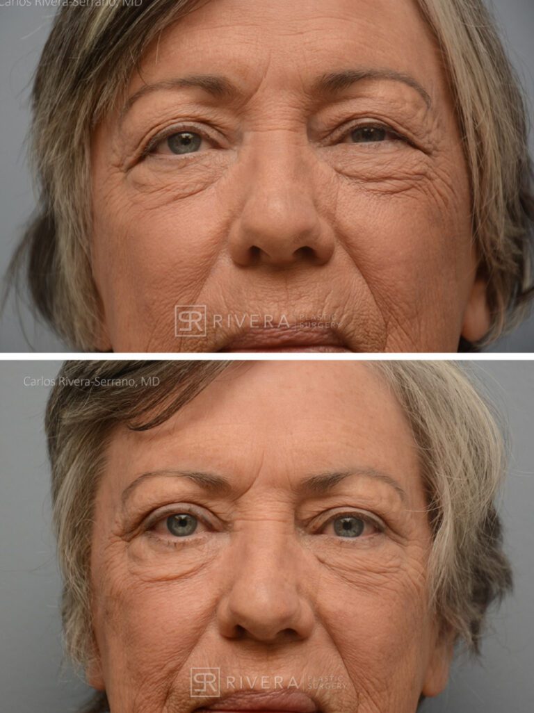 Upper Eyelid Elevation Surgery in female patient - Eyelid & Brow Surgery - Before and after case 6 - Frontal view