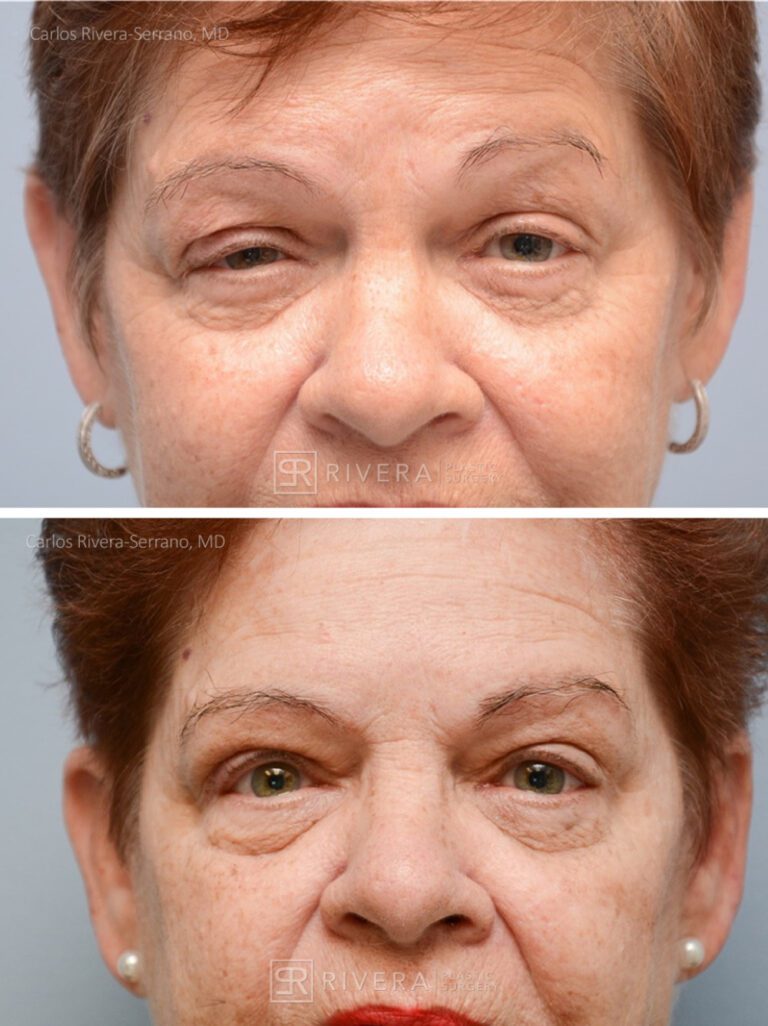 Upper Eyelid Elevation Surgery in female patient - Eyelid & Brow Surgery - Before and after case 7 - Frontal view