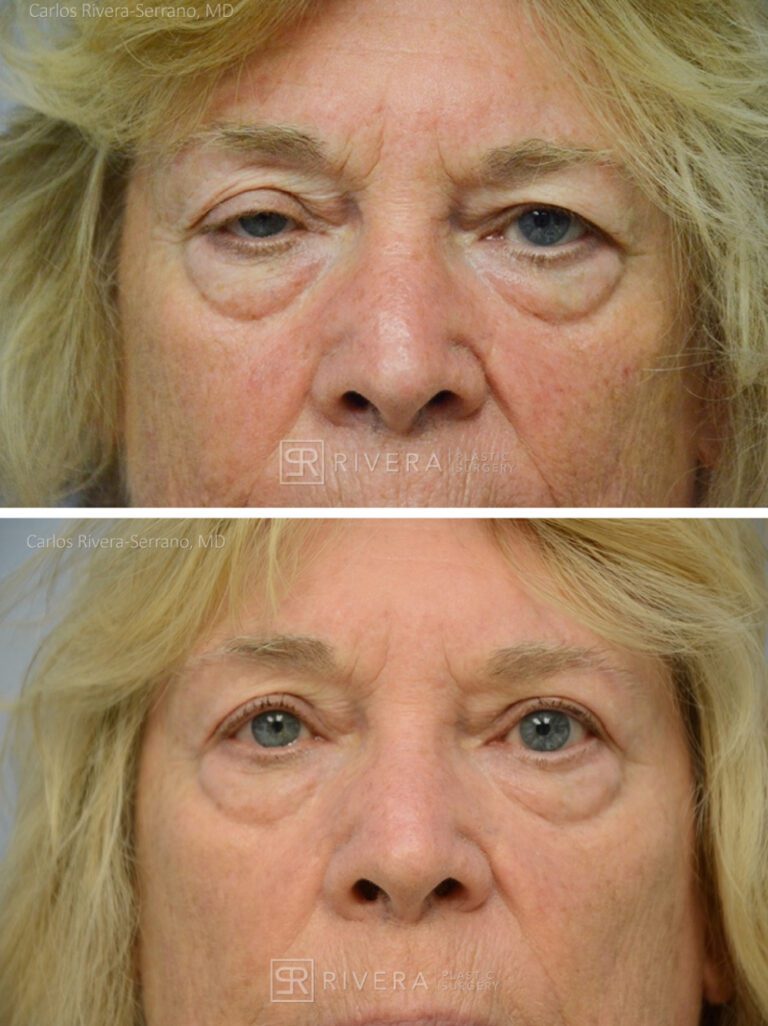 Upper Eyelid Elevation Surgery in female patient - Eyelid & Brow Surgery - Before and after case 8 - Frontal view