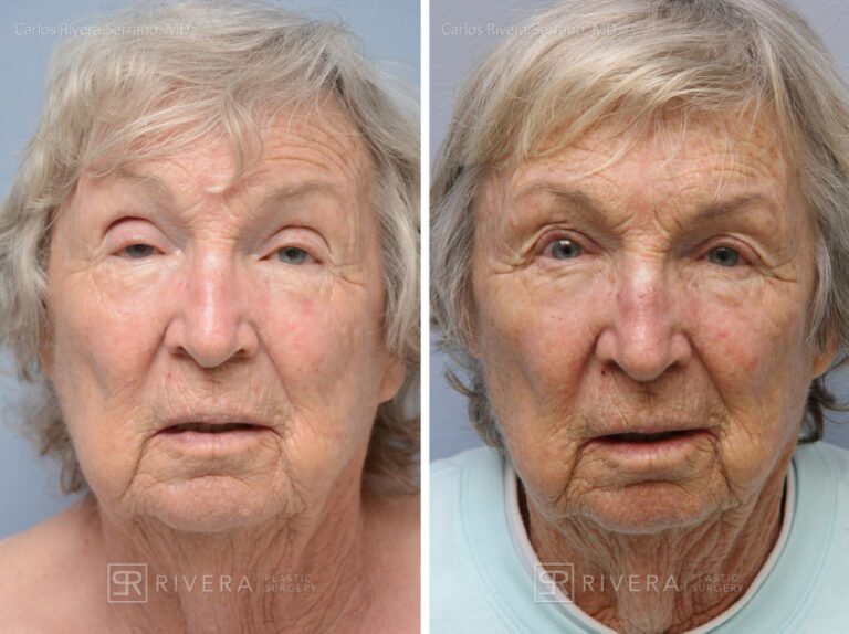 Upper Eyelid Elevation Surgery in female patient - Eyelid & Brow Surgery - Before and after case 9 - Frontal view
