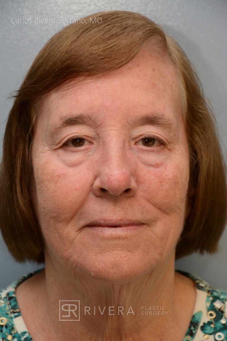 Nasal reconstruction from skin cancer removal with Melolabial flap - Woman - Case 16524 - Postoperative - Frontal view