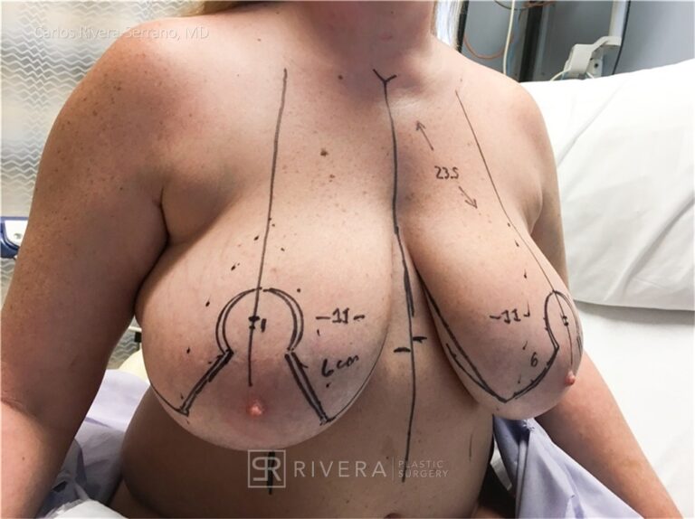 Bilateral breast reduction anteromedial dermoglandular pedicle, Wise skin pattern approach (inverted T) - Woman - Case 2302 - Preoperative - Oblique view