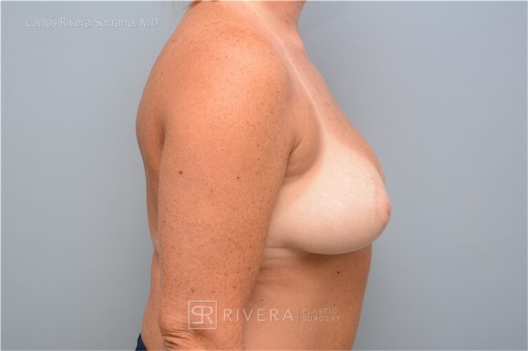 Bilateral breast reduction anteromedial dermoglandular pedicle, Wise skin pattern approach (inverted T) - Woman - Case 2302 - After surgery - Lateral view