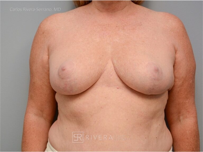 Bilateral breast reduction superomedial dermoglandular pedicle, Wise skin pattern approach (inverted T) - Woman - Case 2301 - After surgery – Frontal view