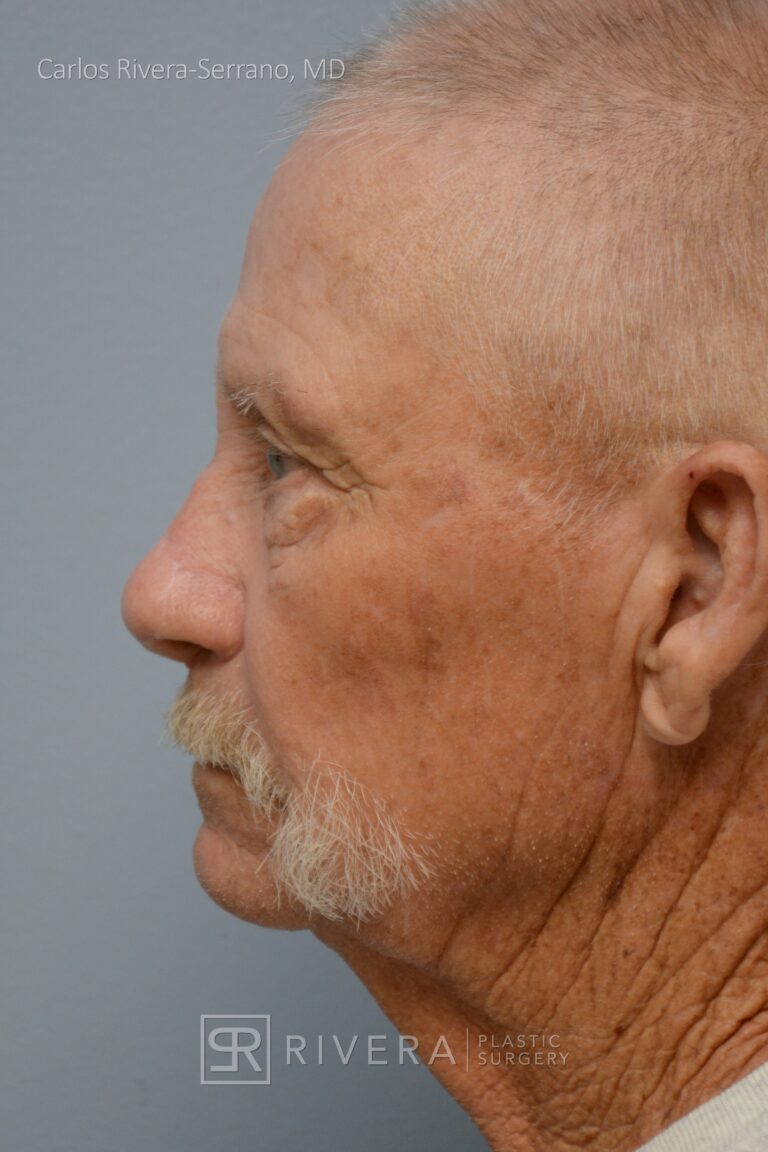 Nasal reconstruction from skin cancer removal with Paramedian Forehead flap - Man - Case 16529 - After surgery - Lateral view