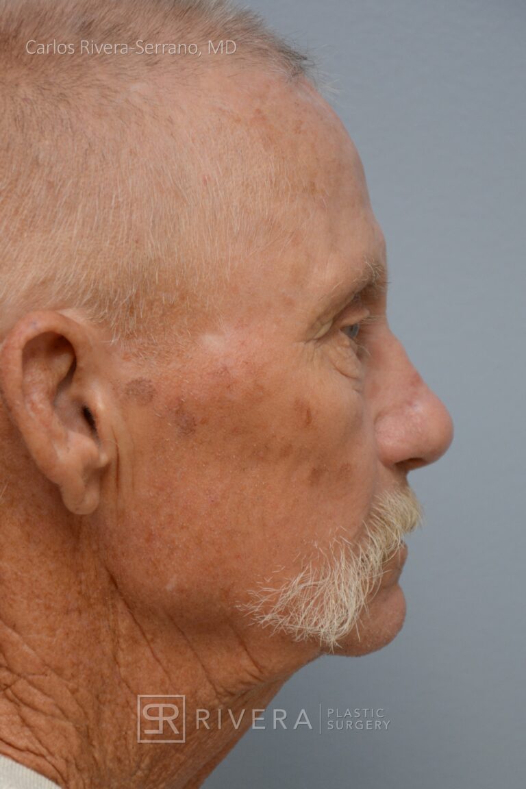 Nasal reconstruction from skin cancer removal with Paramedian Forehead flap - Man - Case 16529 - After surgery - Lateral view