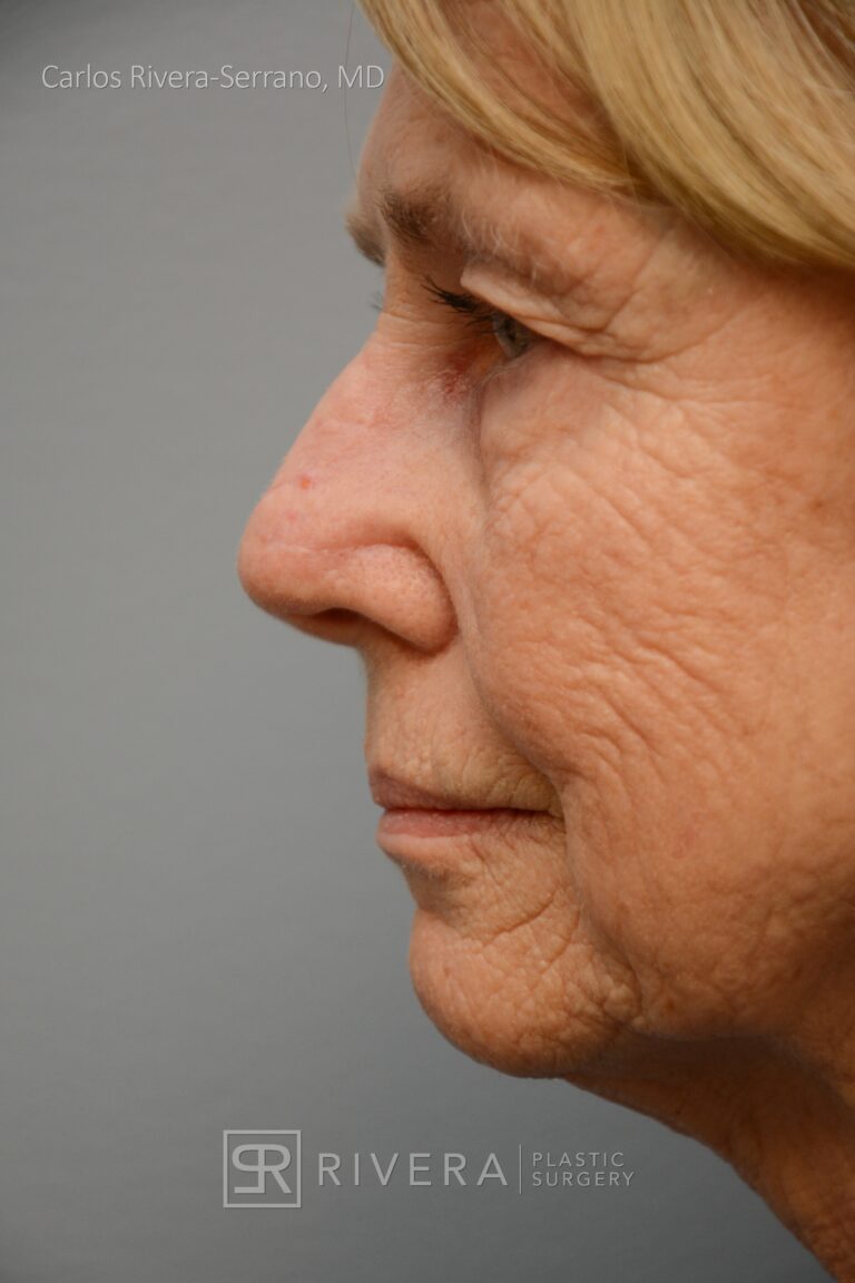 Nose reconstruction from skin cancer removal with Bilobed Rotational flap - Woman - Case 16521 - After surgery - Lateral view