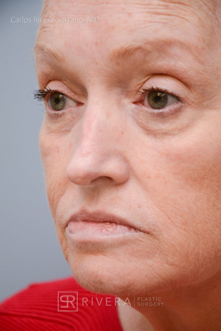 Nose reconstruction from skin cancer removal with Bilobed Rotational flap - Woman - Case 16514 - Postoperative - Oblique view
