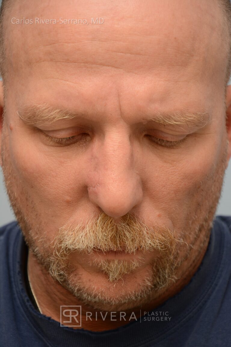 Nasal reconstruction from skin cancer removal with Bilobed Rotational flap - Man - Case 16535 - Postoperative - Frontal view