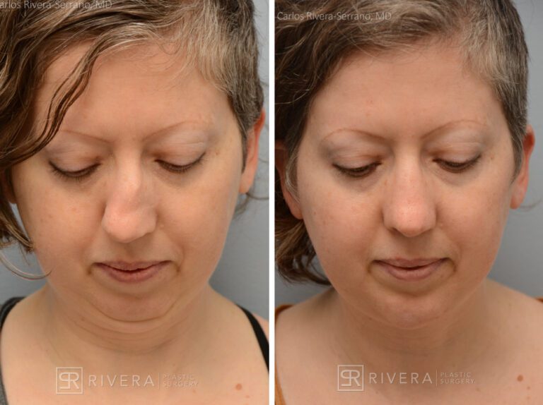 Aesthetic rhinoplasty nose surgery (oblique/front first) in female patient - Nose Surgery (Rhinoplasty) - Before and after case 1 - Superior view