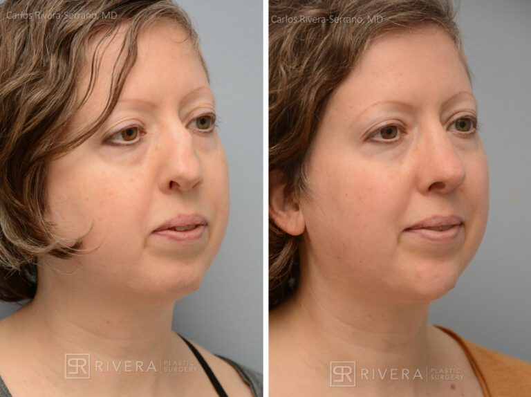 Aesthetic rhinoplasty nose surgery (oblique/front first) in female patient - Nose Surgery (Rhinoplasty) - Before and after case 1 - Lateral view