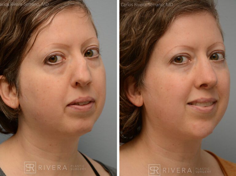 Aesthetic rhinoplasty nose surgery (oblique/front first) in female patient - Nose Surgery (Rhinoplasty) - Before and after case 1 - Lateral view