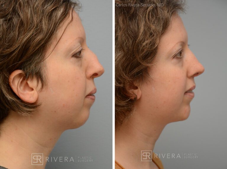 Aesthetic rhinoplasty nose surgery (oblique/front first) in female patient - Nose Surgery (Rhinoplasty) - Before and after case 1 - Profile view