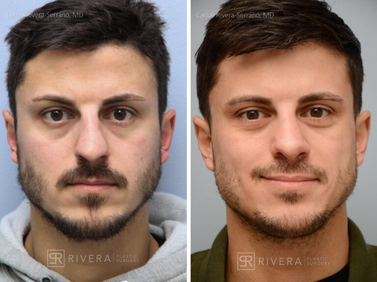 Aesthetic rhinoplasty nose surgery (oblique/front first) in male patient - Nose Surgery (Rhinoplasty) - Before and after case 10 - Frontal view