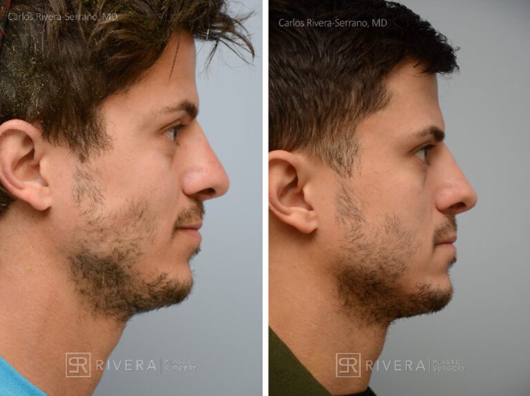 Aesthetic rhinoplasty nose surgery (oblique/front first) in male patient - Nose Surgery (Rhinoplasty) - Before and after case 10 - Profile view