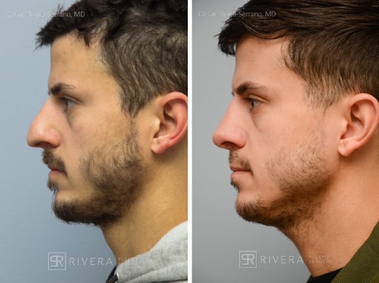 Aesthetic rhinoplasty nose surgery (oblique/front first) in male patient - Nose Surgery (Rhinoplasty) - Before and after case 10 - Profile view