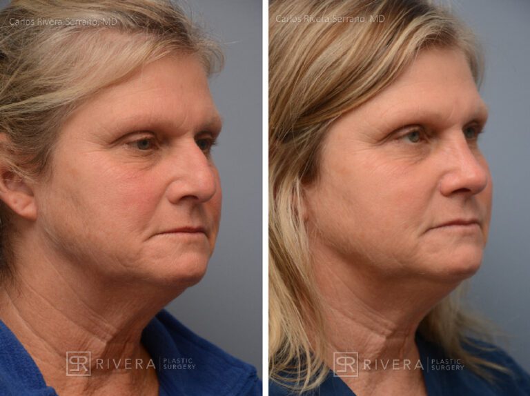 Aesthetic rhinoplasty nose surgery (oblique/front first) in female patient - Nose Surgery (Rhinoplasty) - Before and after case 11 - Lateral view