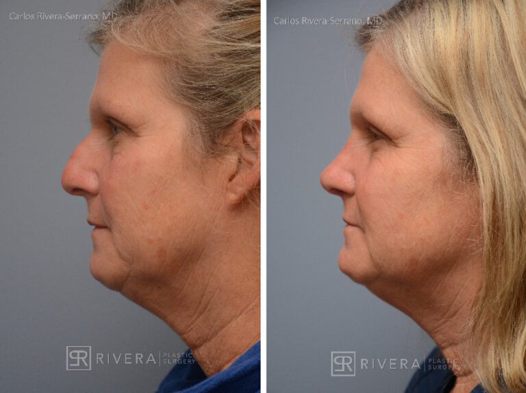 Aesthetic rhinoplasty nose surgery (oblique/front first) in female patient - Nose Surgery (Rhinoplasty) - Before and after case 11 - Profile view