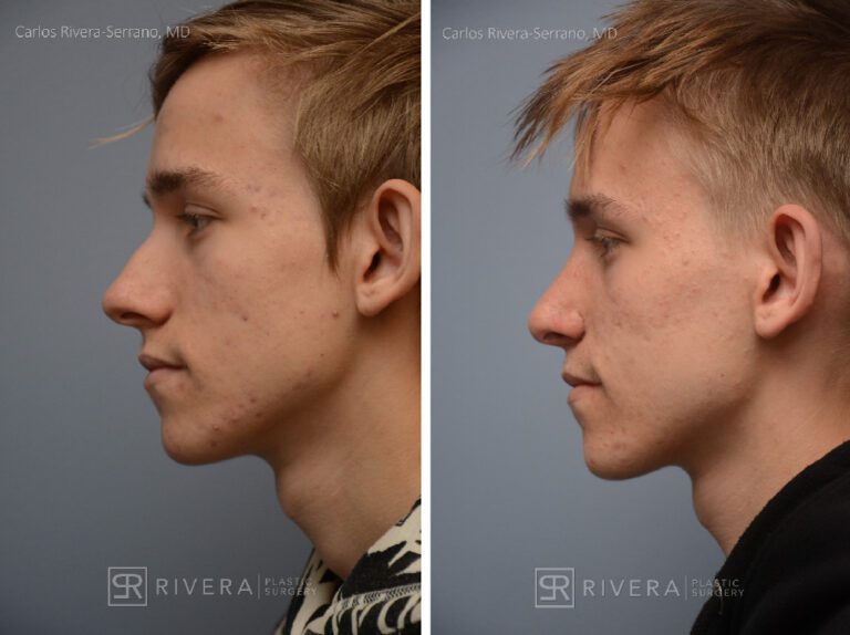Aesthetic rhinoplasty nose surgery (oblique/front first) in male patient - Nose Surgery (Rhinoplasty) - Before and after case 12 - Profile view