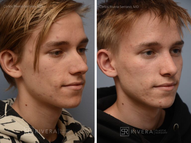 Aesthetic rhinoplasty nose surgery (oblique/front first) in male patient - Nose Surgery (Rhinoplasty) - Before and after case 12 - Lateral view