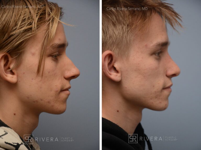 Aesthetic rhinoplasty nose surgery (oblique/front first) in male patient - Nose Surgery (Rhinoplasty) - Before and after case 12 - Profile view