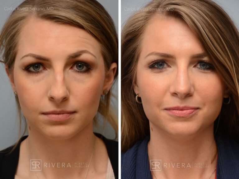 Aesthetic rhinoplasty nose surgery (oblique/front first) in female patient - Nose Surgery (Rhinoplasty) - Before and after case 2 - Front view