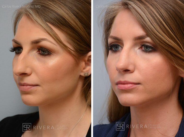 Aesthetic rhinoplasty nose surgery (oblique/front first) in female patient - Nose Surgery (Rhinoplasty) - Before and after case 2 - Lateral view