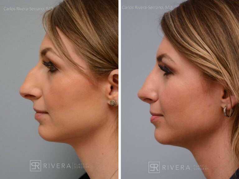 Aesthetic rhinoplasty nose surgery (oblique/front first) in female patient - Nose Surgery (Rhinoplasty) - Before and after case 2 - Profile view