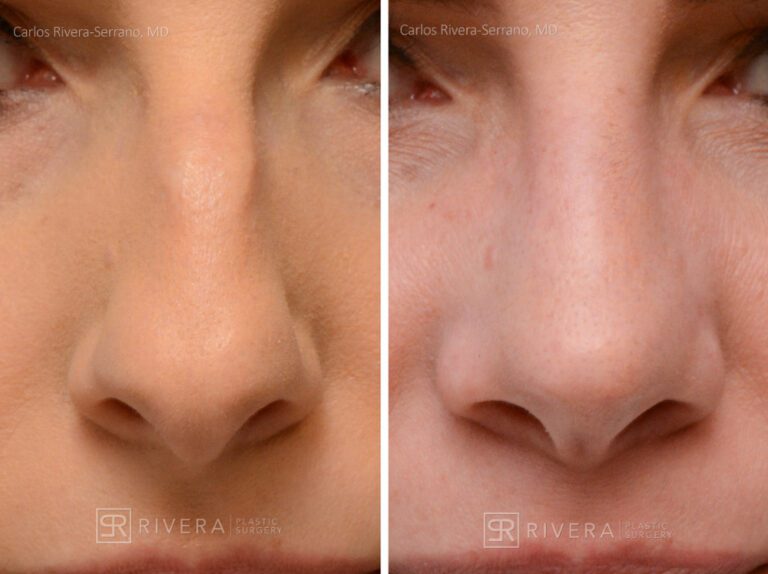 Aesthetic rhinoplasty nose surgery (oblique/front first) in female patient - Nose Surgery (Rhinoplasty) - Before and after case 2 - Zoomed front view