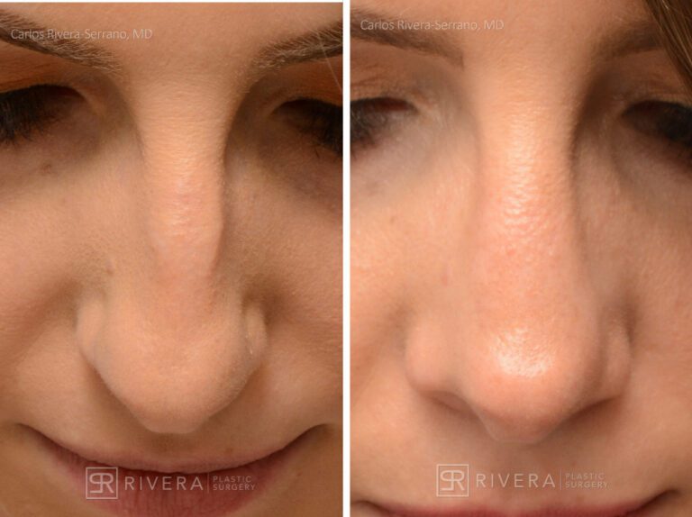 Aesthetic rhinoplasty nose surgery (oblique/front first) in female patient - Nose Surgery (Rhinoplasty) - Before and after case 2 - Zoomed superior view