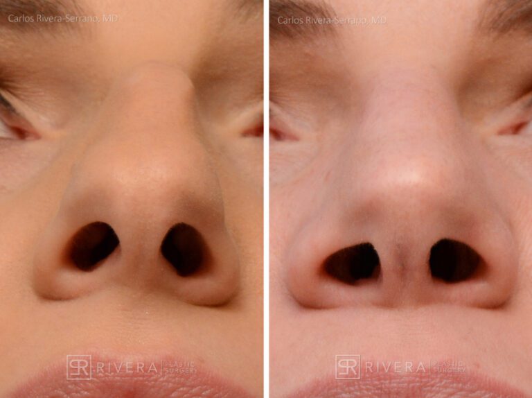 Aesthetic rhinoplasty nose surgery (oblique/front first) in female patient - Nose Surgery (Rhinoplasty) - Before and after case 2 - Zoomed inferior view