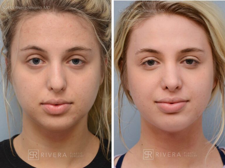 Aesthetic rhinoplasty nose surgery (oblique/front first) in female patient - Nose Surgery (Rhinoplasty) - Before and after case 3 - Frontal view