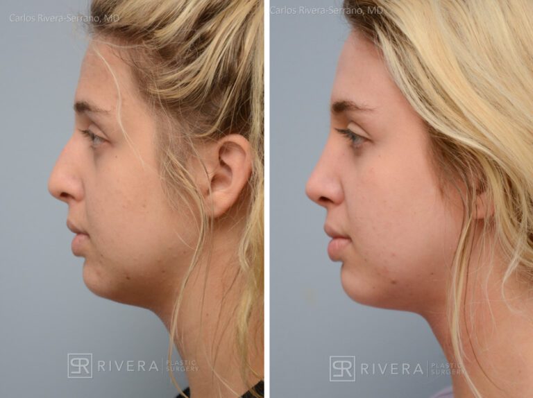 Aesthetic rhinoplasty nose surgery (oblique/front first) in female patient - Nose Surgery (Rhinoplasty) - Before and after case 3 - Profile view