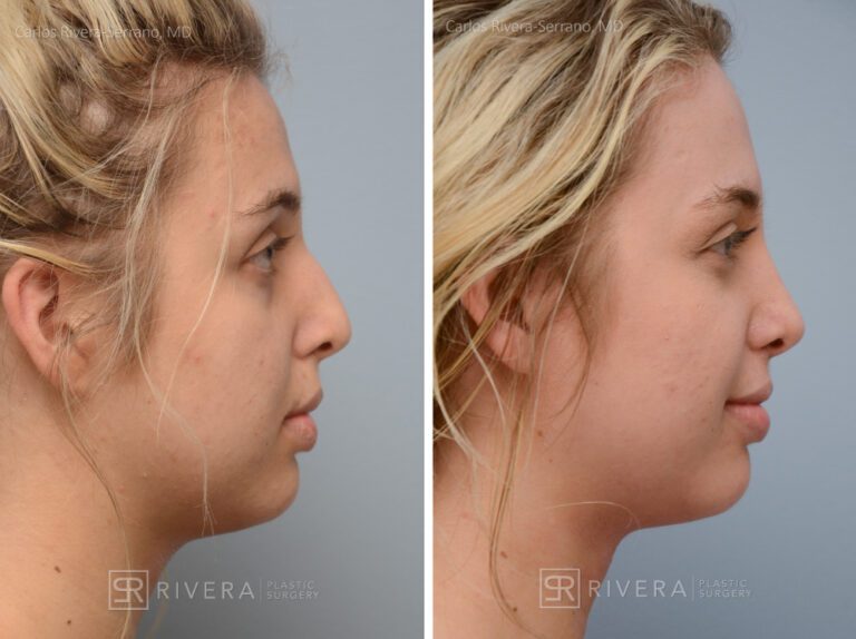 Aesthetic rhinoplasty nose surgery (oblique/front first) in female patient - Nose Surgery (Rhinoplasty) - Before and after case 3 - Profile view