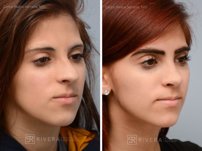 Aesthetic rhinoplasty nose surgery (oblique/front first) in female patient - Nose Surgery (Rhinoplasty) - Before and after case 4 - Lateral view