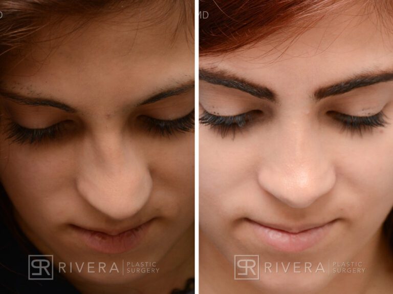 Aesthetic rhinoplasty nose surgery (oblique/front first) in female patient - Nose Surgery (Rhinoplasty) - Before and after case 4 - Superior view