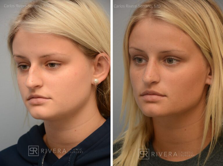 Aesthetic rhinoplasty nose surgery (oblique/front first) in female patient - Nose Surgery (Rhinoplasty) - Before and after case 5 - Lateral view
