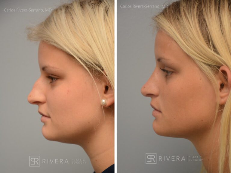Aesthetic rhinoplasty nose surgery (oblique/front first) in female patient - Nose Surgery (Rhinoplasty) - Before and after case 5 - Profile view
