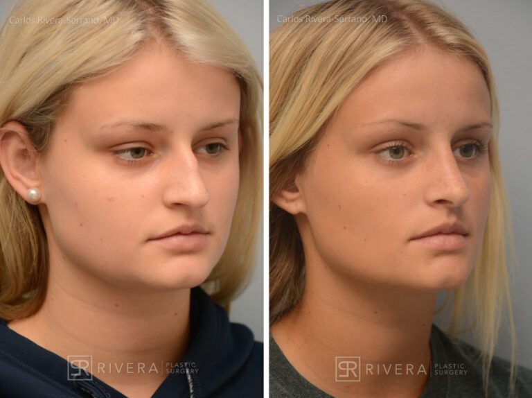 Aesthetic rhinoplasty nose surgery (oblique/front first) in female patient - Nose Surgery (Rhinoplasty) - Before and after case 5 - Lateral view