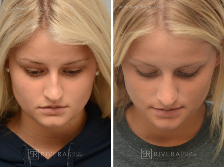 Aesthetic rhinoplasty nose surgery (oblique/front first) in female patient - Nose Surgery (Rhinoplasty) - Before and after case 5 - Superior view
