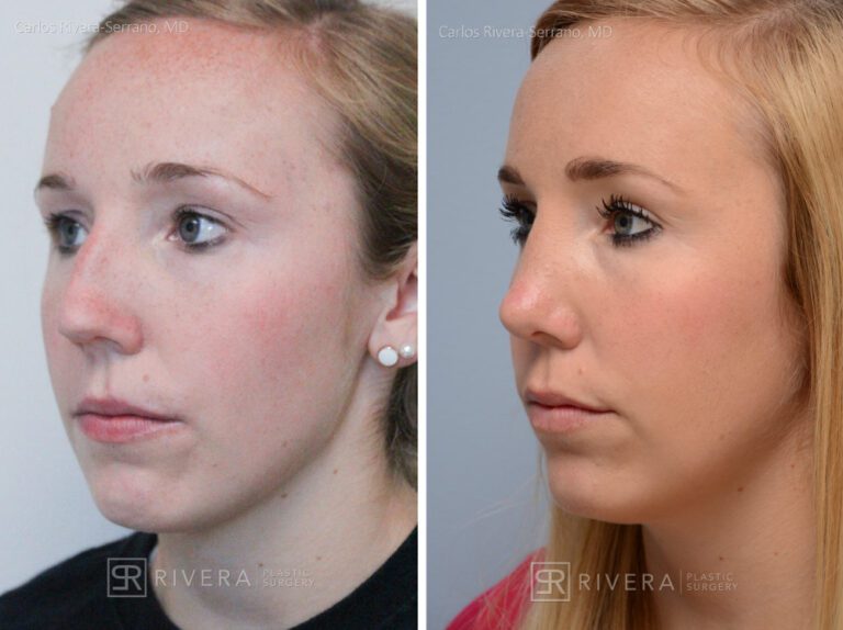 Aesthetic rhinoplasty nose surgery (oblique/front first) in female patient - Nose Surgery (Rhinoplasty) - Before and after case 6 - Lateral view